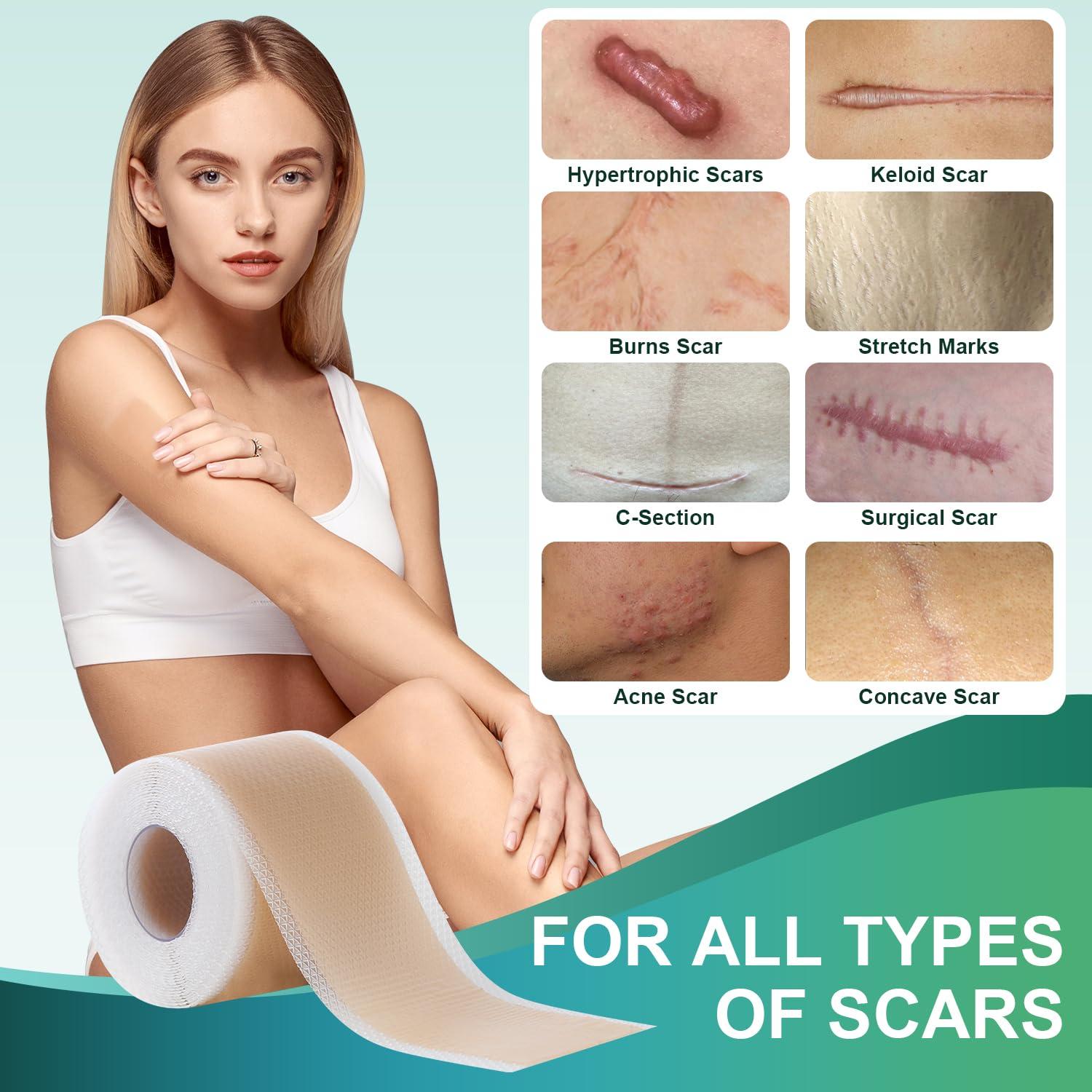 Gowgaw Medical Grade Silicone Scar Sheets, Silicone Scar Tape (1.6x 60 Roll-1.5M), Professional Scar Removal Treatment, Reusable Silicone Scar Strip for Keloid, C-Section, Surgery, Burns, Acne Etc