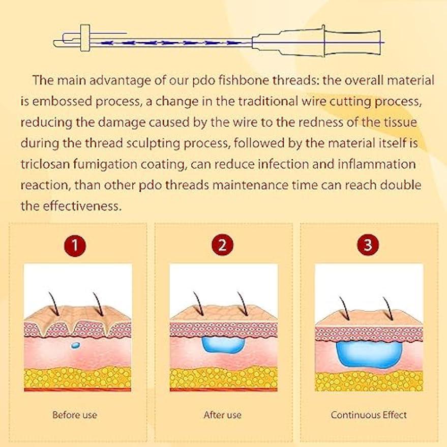 MatYas Pdo Pcl Fishbone Threads, Cog Threads 18G100mm, Barb Threads, W-Type Blunt, Lifting and Firming Anti-Aging, 20Pcs (PDO)