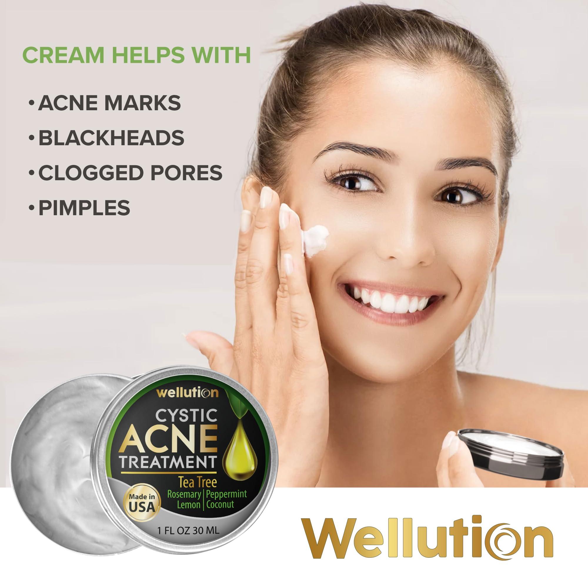 WELLUTION Wellution Cystic Acne Treatment Cream - Natural Pimple and Scar Remover with Tea Tree Oil - Effective Overnight Face Treatment for Acne Spots, Pimples and Scars - 1oz