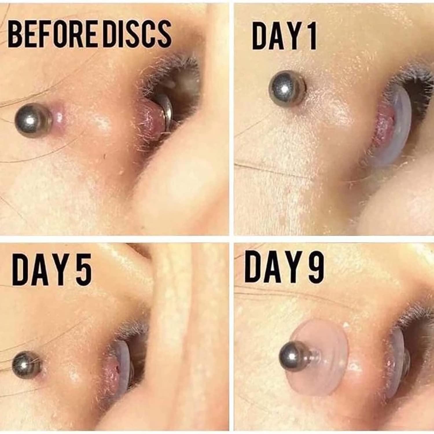 Bloomfall Bloomfall Clear Piercing Disc For Piercing Bump,Pressure Silicone Earrings For Keloids Healing Pads Belly Button Piercing Kit Nose Piercing Bump Treatment (5MM 8PCS)