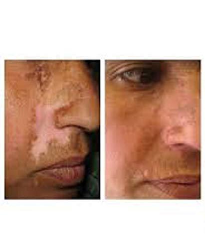 Fiico Melgain Lotion for Vitiligo/White Patches: Decapeptide : Stimulates Pigmentation 10ml (Pack OF 2) - With Express Shipping