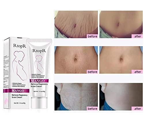 MQUPIN RtopR Mango Stretch Marks and Scar Cream -Stretch Marks and Scar Removal Cream for Pregnancy - Best Body Moisturizer-40g