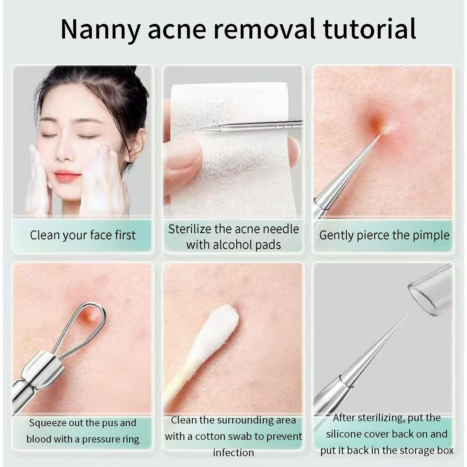 Mrchrogge Mrchrogge Facial Blackhead Remover Tweezers,Stainless Steel Portable Acne Needle Double Head,Squeeze Pick Acne Blackhead Needle Acne Needle Acne Needle (Pink)