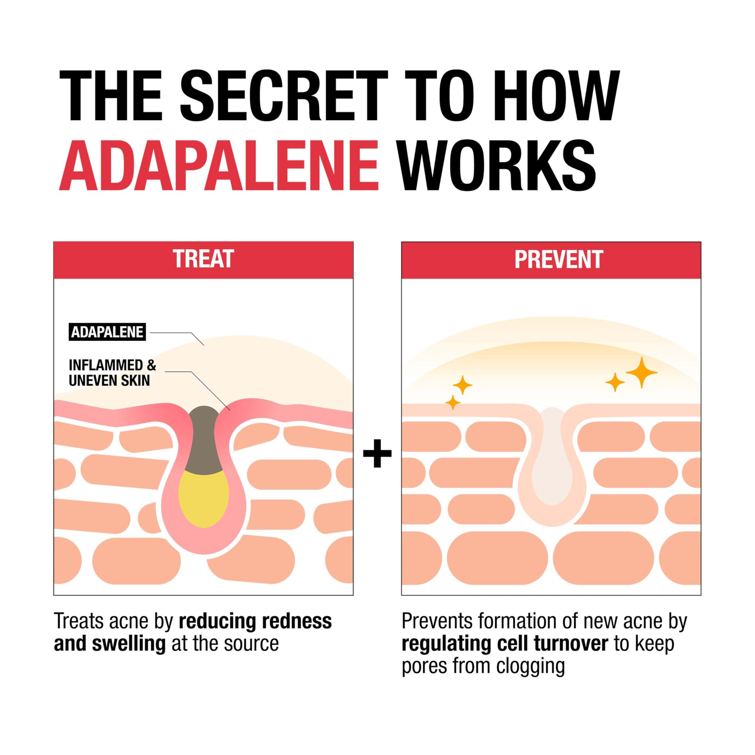 Neutrogena Neutrogena Adapalene Gel Acne Treatment, 0.1% Adapalene Acne Medication for Pimples & Blemishes, Once Daily Topical Retinoid Gel to Help Fight Breakouts, Oil- & Fragrance-Free, 1.6 oz