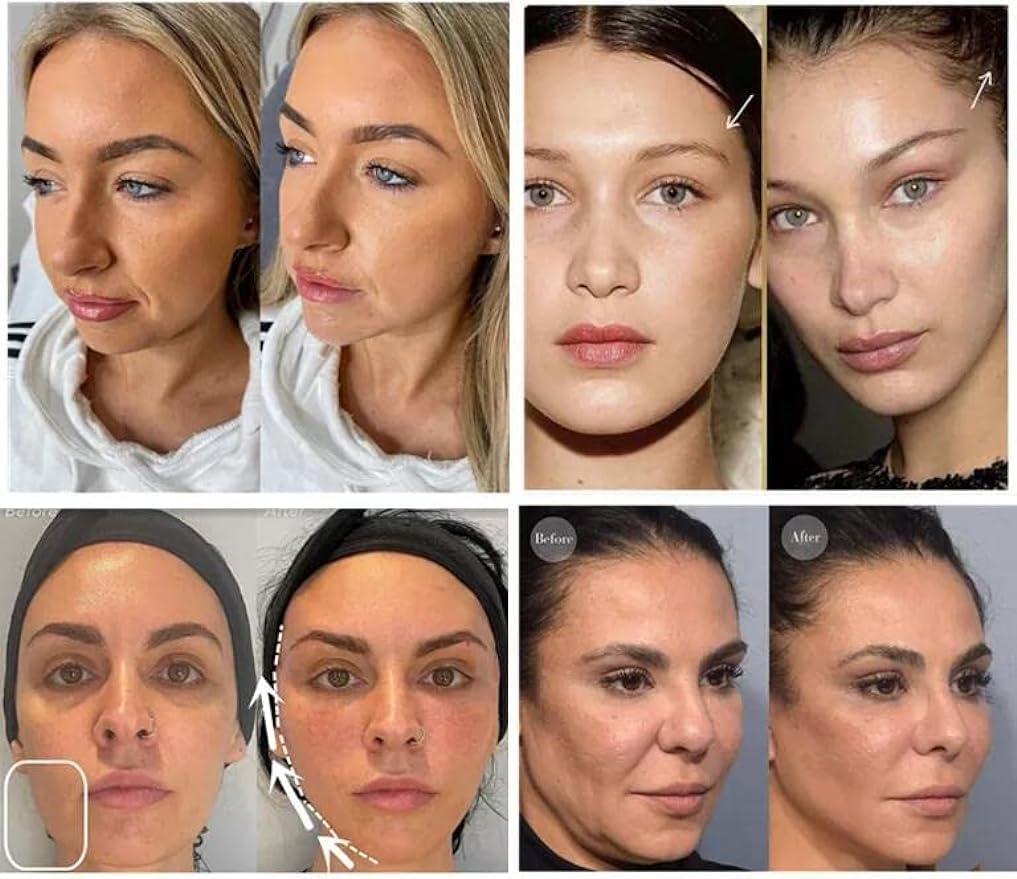 MatYas Pdo Cog 6D Threads 19G100MM, W-Type, 360R Bidirection Cog for Face Lift, 20pcs